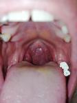 Ком в горле, опухшие миндалины фото 2