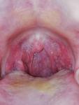 Ком в горле, опухшие миндалины фото 1