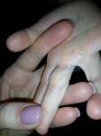 Облазит кожа на пальцах рук у ребенка фото 3