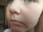 Раздражение вокруг носа у ребенка фото 2