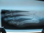 Перелом основания 5 плюсневой кости и ортез фото 2