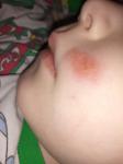 Пятно на лице у ребенка фото 2
