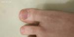 Тёмное пятно на ногте большого пальца фото 1
