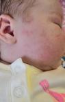 Сыпь на лице ребенка фото 1