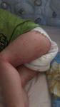 Пятна на теле ребенка, это аллергия или крапивница или клопы фото 4
