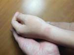 Изменение кожи рук у ребёнка фото 4