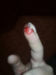 Болит палец после вмешательства фото 5