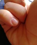 Изменение ногтевой пластины фото 5