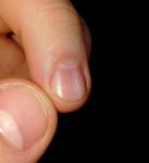 Изменение ногтевой пластины фото 4