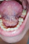 Воспаление языка и горла фото 5