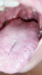 Воспаление языка и горла фото 2