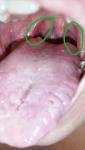 Воспаление языка и горла фото 1