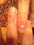 Повреждение сустава пальца фото 1