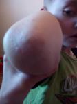 Сыпь на локтях у ребенка 5-ти лет фото 3