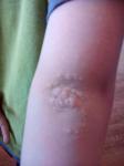 Сыпь на локтях у ребенка 5-ти лет фото 2