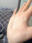 Сыпь на руке после Грандаксина фото 2