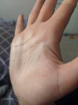 Сыпь на руке после Грандаксина фото 1