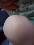 Пятно у на колене ребенка фото 1