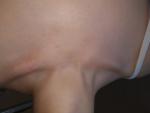Атопический дерматит и прыщи на коже груди фото 1