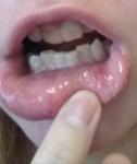 Стоматит, с боку болит ужасно язык и распух фото 3