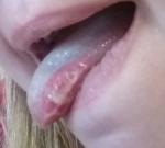 Стоматит, с боку болит ужасно язык и распух фото 2