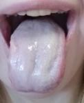 Стоматит, с боку болит ужасно язык и распух фото 1