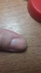 Полоса вертикальная на ногте большого пальца фото 1