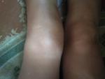 Травма коленного сустава. Разрыв передней крестообразной связки. Блокада сустава фото 2