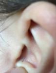 Полая дырка в ушной раковине фото 1