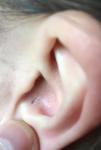 Полая дырка в ушной раковине фото 2