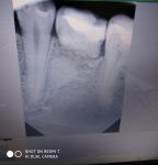 Рентгеновский снимок зуба, новообразование? фото 1