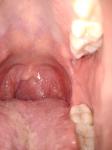Инфекции в горле и краснота фото 1