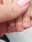 Синдром наперстка на ногтях у девочки 7 лет? фото 2