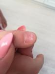 Синдром наперстка на ногтях у девочки 7 лет? фото 1