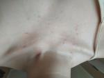 Атопический дерматит и прыщи на коже груди фото 2