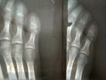 Перелом мизинца ноги фото 1