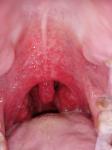 Как лечить горло если не помогает антибиотик азитромицын фото 3