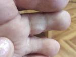 Плотная шишка на втором пальце ноги, снизу фото 2