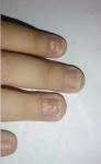 Дистрофия ногтя или грибок ногтя фото 1