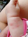 Волдыри на рукеу ребёнка 3 месяца нк фото 1