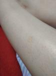 Единичное телесно-розовое пятно на ноге фото 3