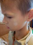 Белое пятно на щеке у ребенка 10 лет фото 2