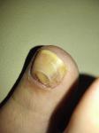 Проблема ногтей фото 2