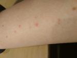 Как лечить такой тип аллергии? фото 4
