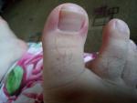 Панацирий воспаление около ногтей большого пальца ноги как лечить фото 3