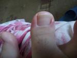 Панацирий воспаление около ногтей большого пальца ноги как лечить фото 1