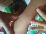 Сыпь на кистях рук у ребёнка фото 1