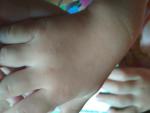 Сыпь на кистях рук у ребёнка фото 2