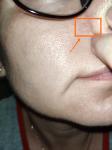 Что с крылом носа-аллергия? фото 2