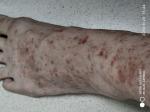Кровяные высыпания на ногах, диагноз Васкулит не могут поставить фото 2